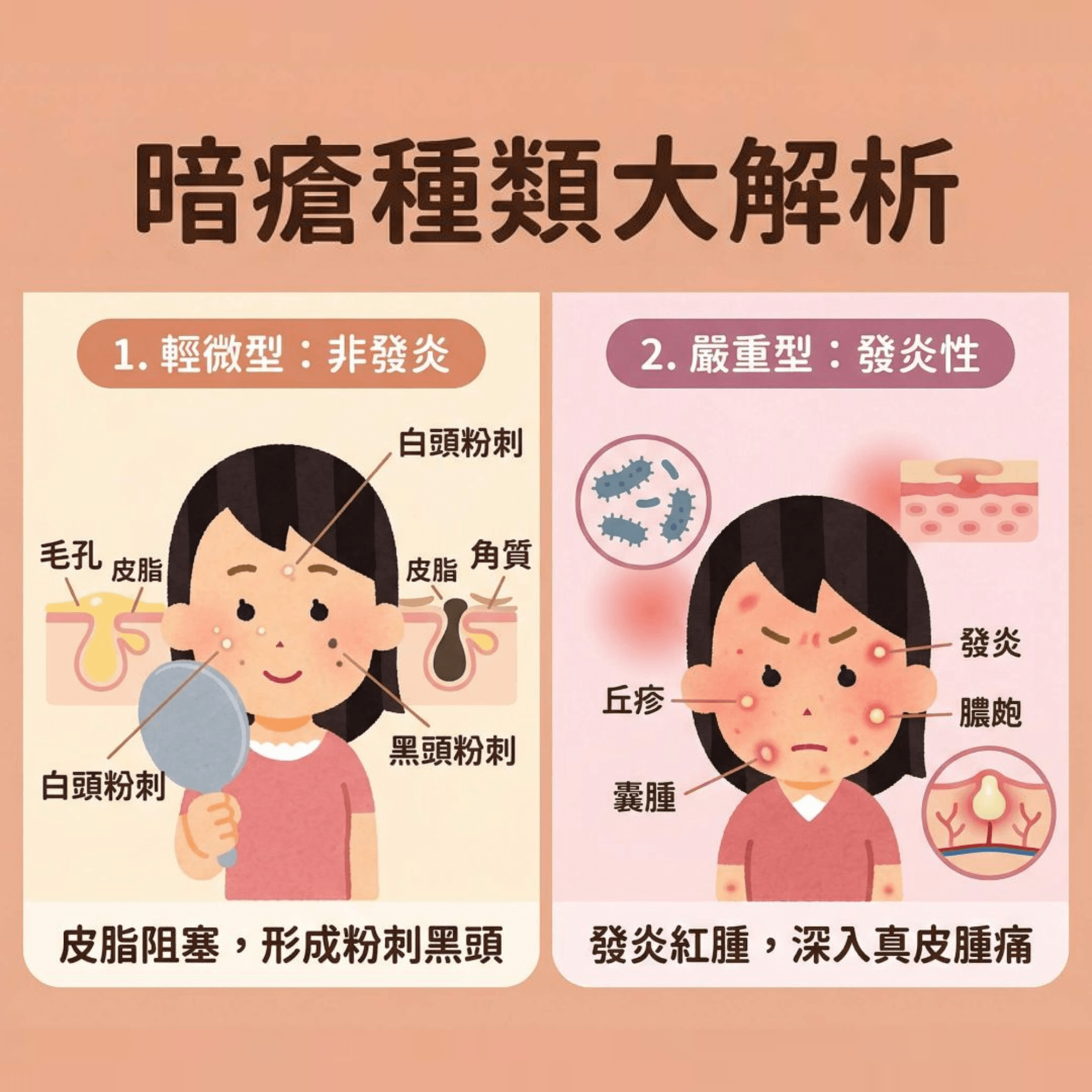 這是一張 1:1 正方形的扁平化向量資訊圖表插畫,採用了現代醫療健康風格,配以可愛的 Irasutoya 插圖。圖表標題為「暗瘡種類大解析」,上方有「對症下藥 拒絕疤痕」等膠囊形副標題。主體分為兩個彈性網格方格:左側是「輕微型:非發炎」,插圖展示一個女孩照鏡子,臉上有白頭、黑頭粉刺,毛孔因皮脂腺分泌過度而堵塞,說明文字為「皮脂阻塞,形成粉刺黑頭」;右側是「嚴重型:發炎性」,插圖呈現紅腫發炎的丘疹、膿皰、囊腫,深入真皮層並伴隨細菌滋生(如痤瘡丙酸桿菌),說明文字為「發炎紅腫,深入真皮腫痛」。整張圖表配色柔和,文字使用方圓體,清晰可見且具備較大字距。這張圖表可作為青春痘治療、皮膚分析療程、代謝老廢角質、深層清潔毛孔等內容的教學。