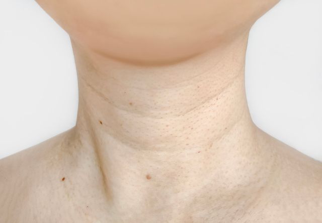 Skin Tightening: Does Thermage Work on Neck? | Perfect Medical