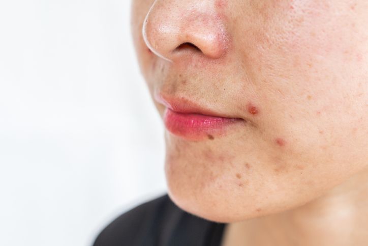 Avoid Foods That Can Cause Acne: The Ultimate Guide to Acne-Free ...