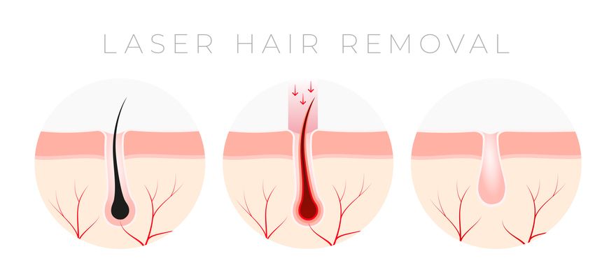 Say Goodbye To Unwanted Hair With Laser Hair Removal Perfect Medical