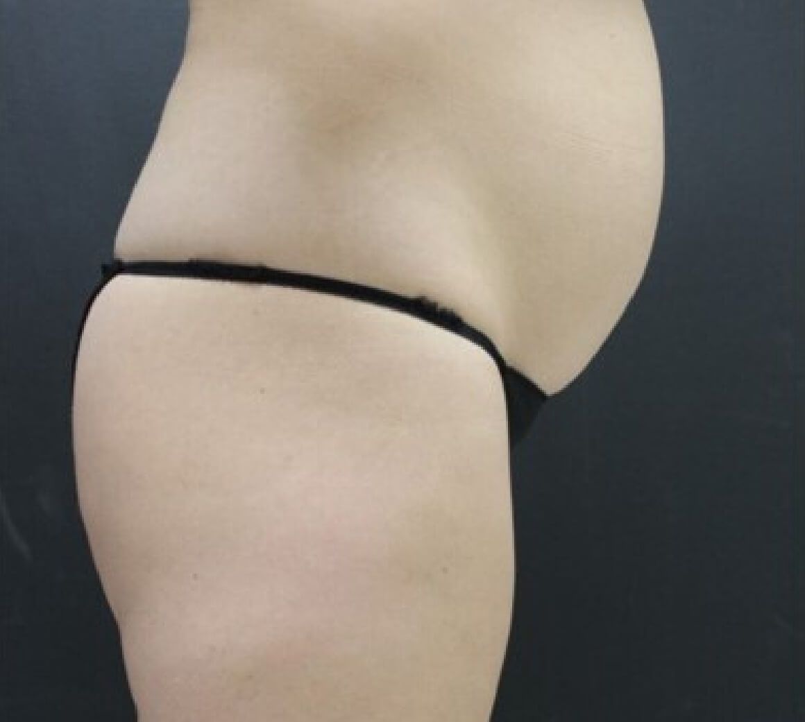 S6 Body Sculpting Treatment: How Does Bio-laser with Vacuum Suction Induce  Fat Reduction? ｜New Beauty SG